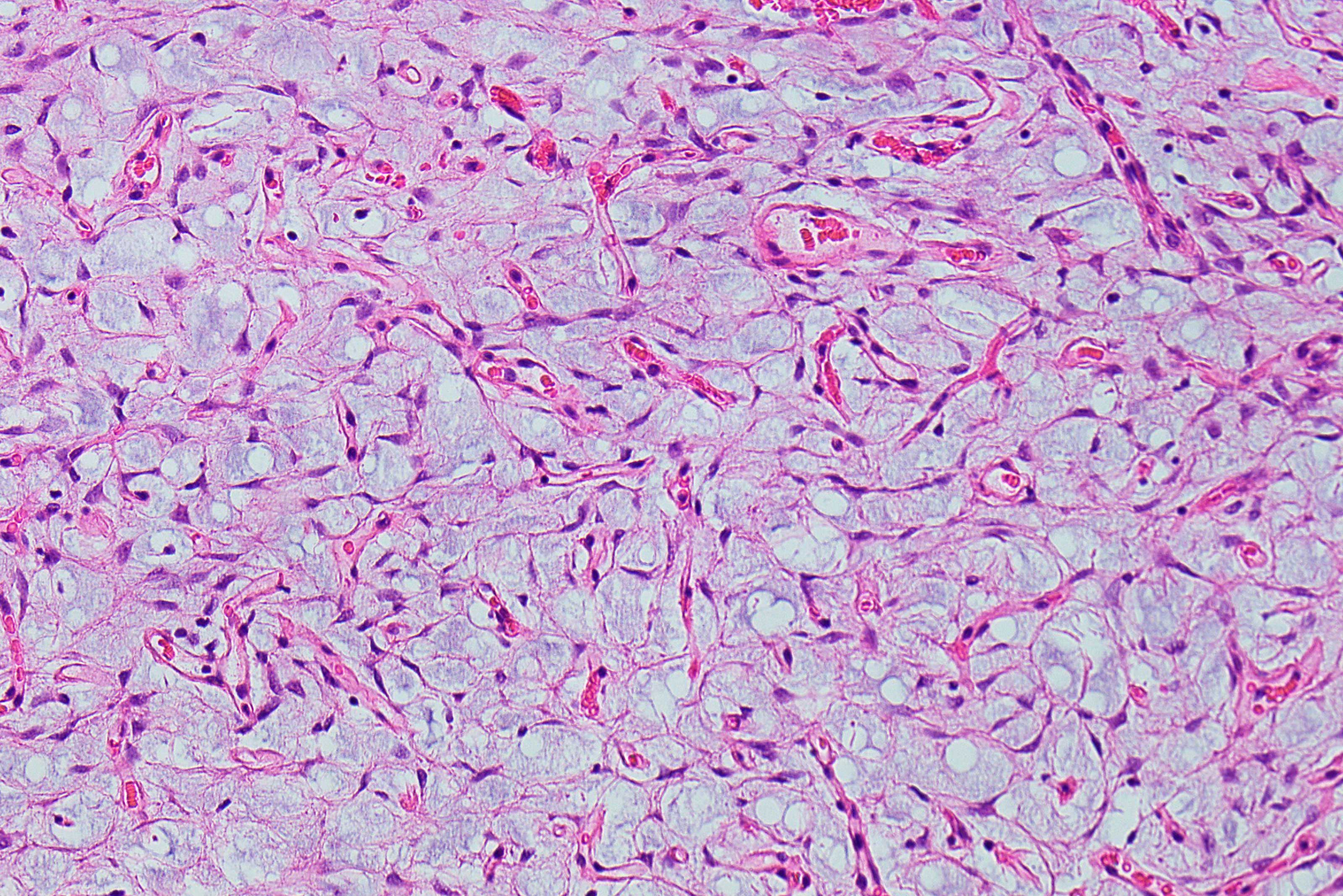 Sarcoma Soft Tissue Tumour